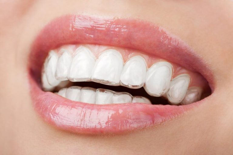 Invisalign: Why Is Invisalign A Clear Alternative To Braces?