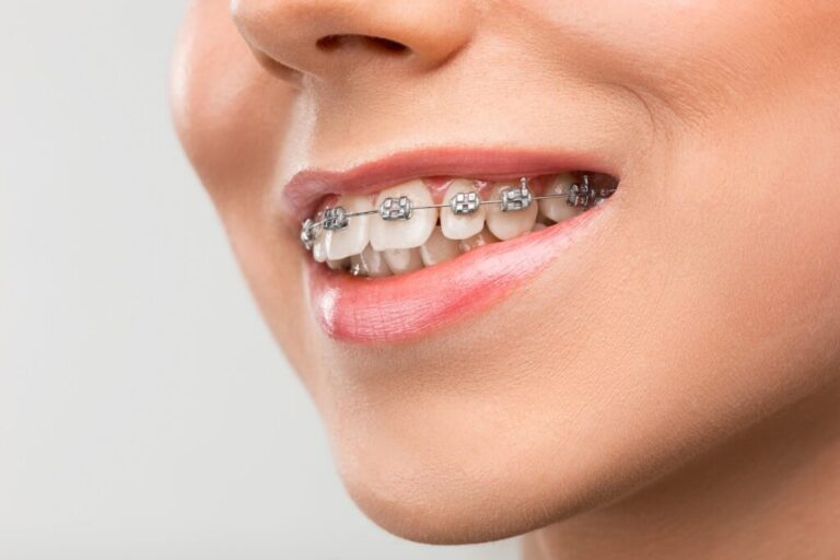 Straight Talk: Unveiling the Benefits of Traditional Metal Braces